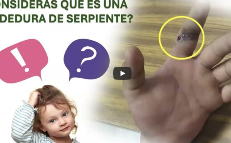 Manejo Inicial De Mordedura De Serpiente